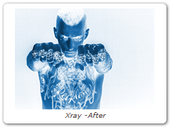 Xray -After