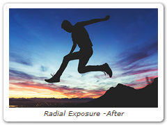 Radial Exposure -After